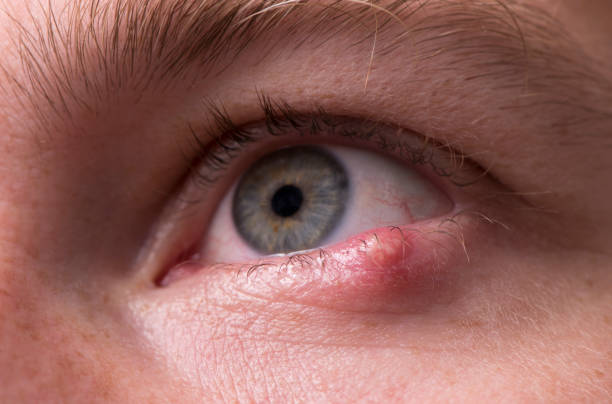 How to Get Rid of a Stye Quickly