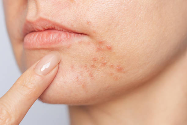 How to Get Rid of Acne on Chin Quickly at Home