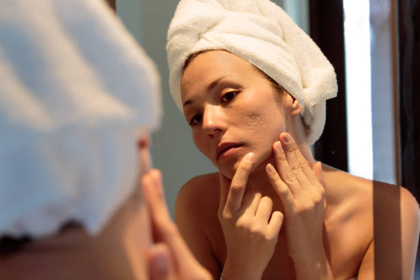 How to Get Rid of Acne Scars Quickly at Home