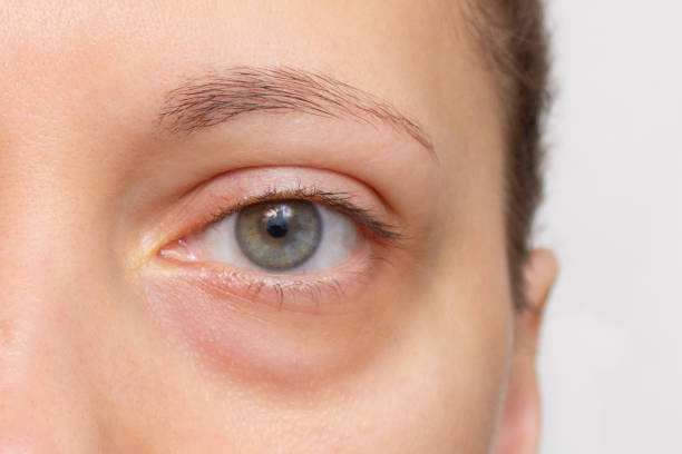 How to Get Rid of Bags Under Eyes Quickly