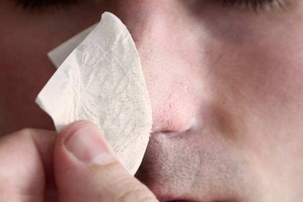 How to Get Rid of Blackheads Quickly