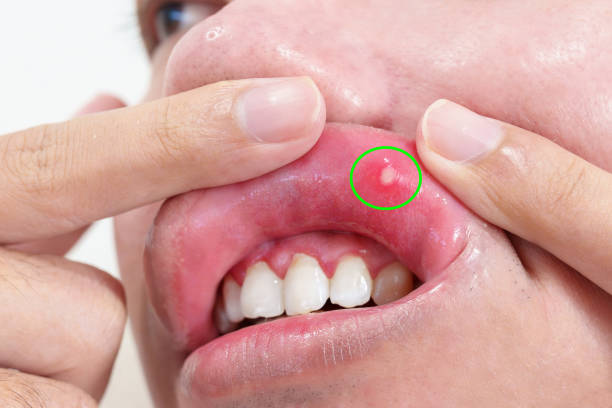 How to Get Rid of Canker Sores Quickly