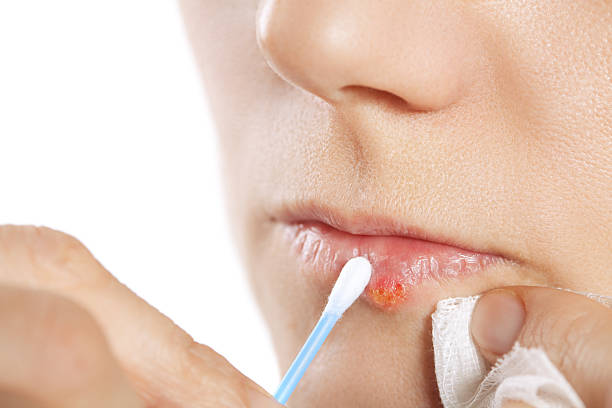 How to Get Rid of Cold Sores at Home Quickly