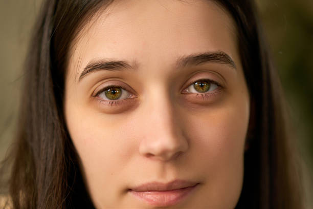 How to Get Rid of Dark Circles Under Eyes