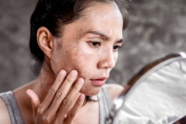 How to Get Rid of Dark Spots on Face Quickly